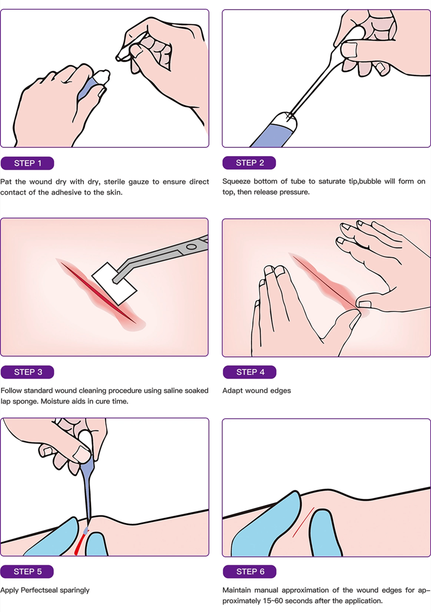 Instructions for surgical glue
